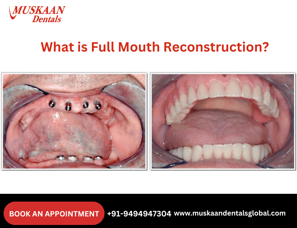 What is Full Mouth Reconstruction