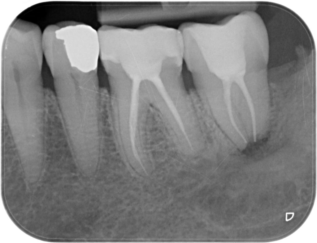 Periapical Cyst