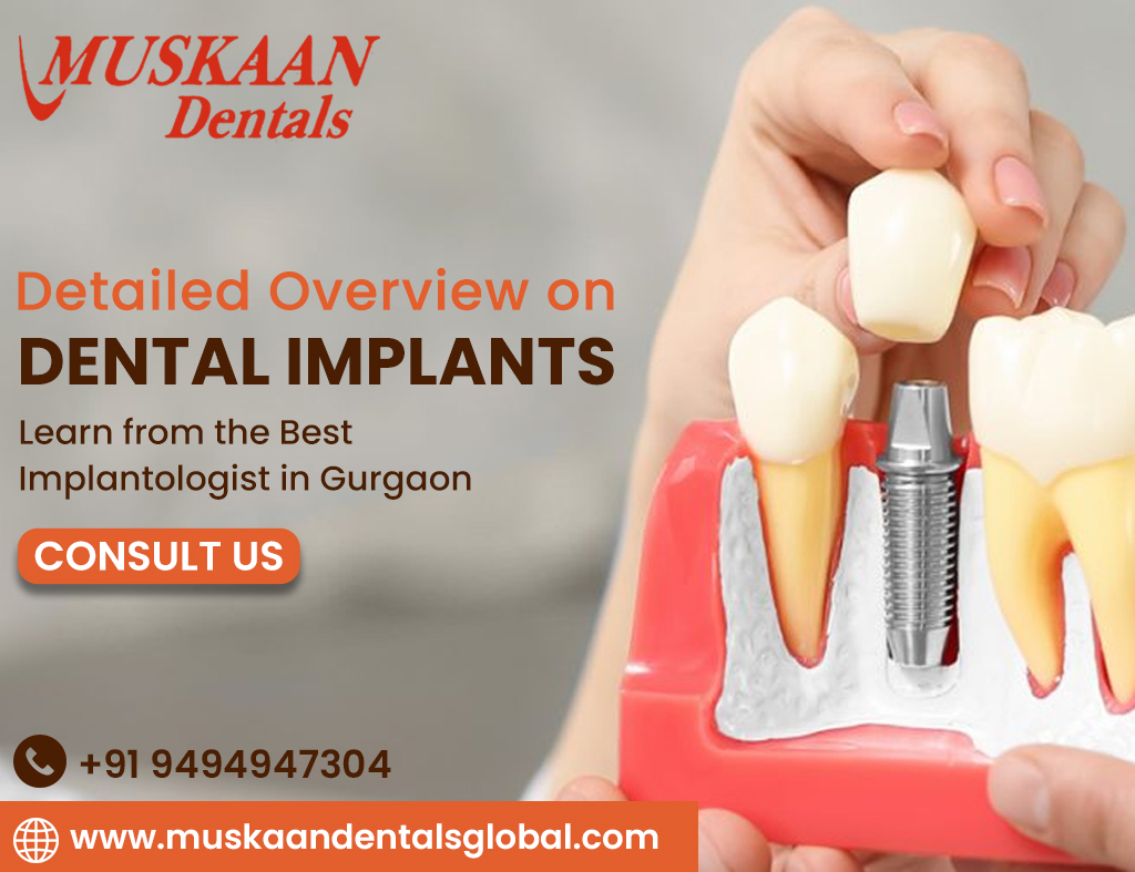 Detailed Overview on Dental Implants