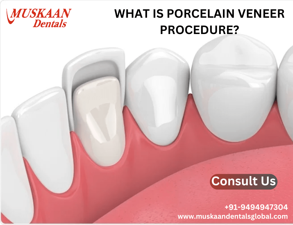 What is Porcelain Veneer Procedure?