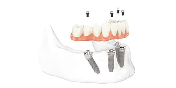 Dental Implants