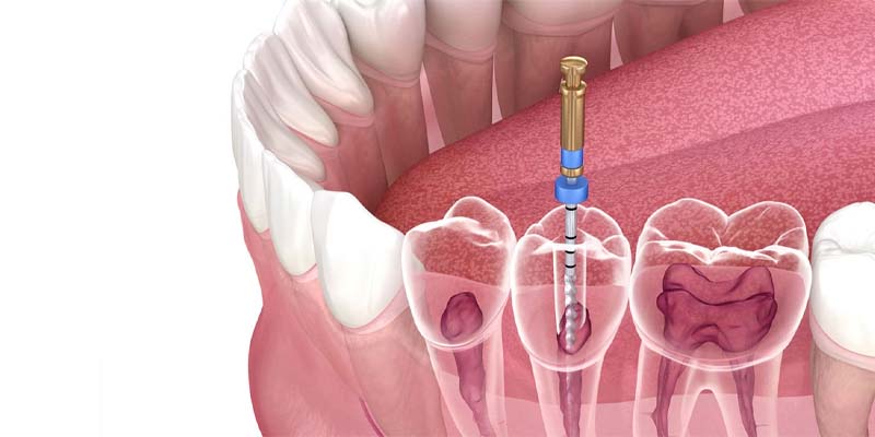 Root Canal 